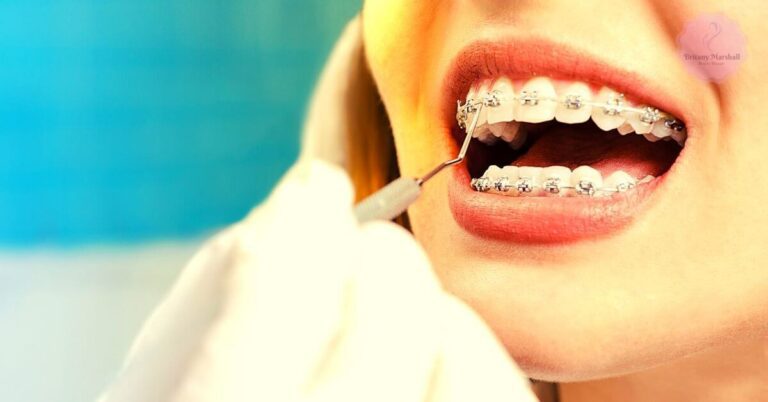 a person with silver metallic braces undergoing dental cleaning by a professional using a dental tool