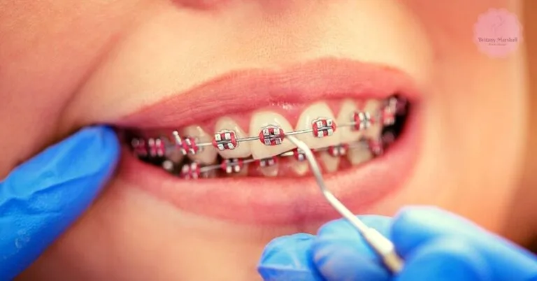 a person’s mouth with orthodontic braces showing a loose bracket being addressed by a dental professional using a tool.
