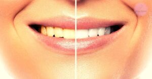 10+ Ways How To Get Rid of Yellow Teeth & Stains!