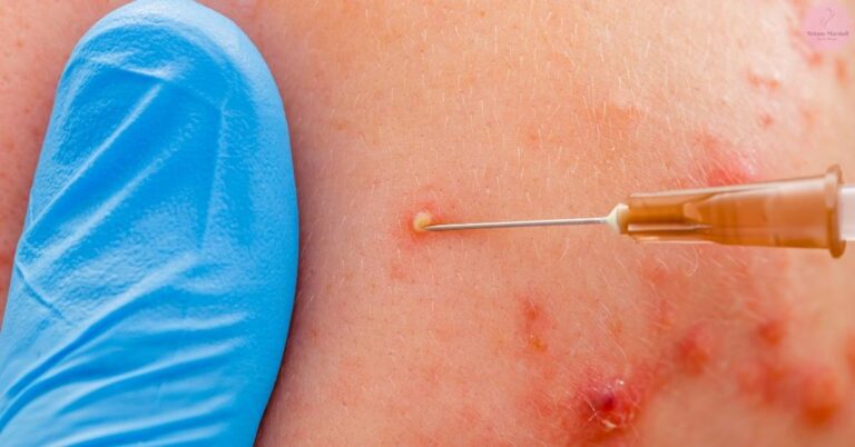 a close-up of a syringe injecting a small amount of medication into skin, next to a blue medical glove.