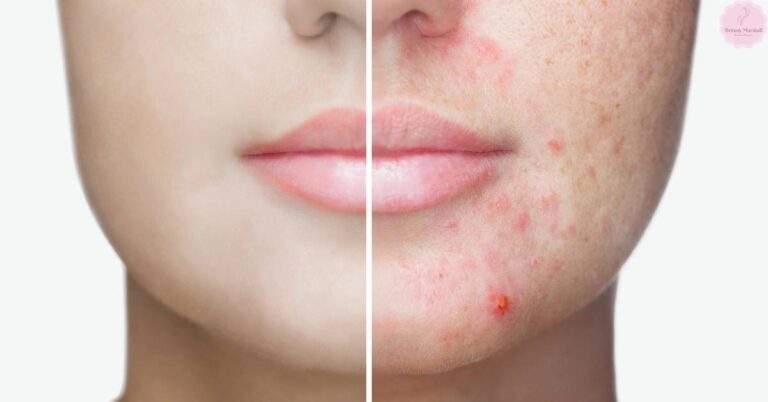 a before-and-after comparison of skin with acne blemishes and improved skin texture after treatment