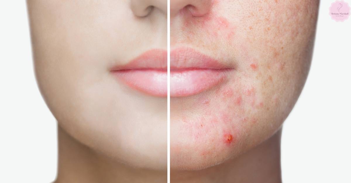 a before-and-after comparison of skin with acne blemishes and improved skin texture after treatment