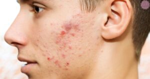 Fungal Acne vs Closed Comedones: Differences & Best Treatment!