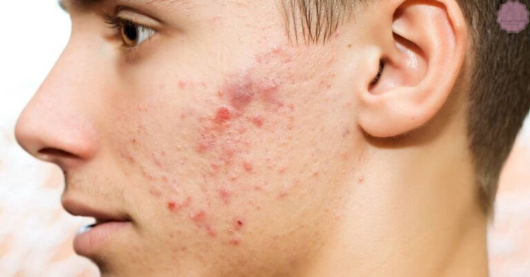 a person’s skin showing small red bumps and irritation near the cheek and ear area, resembling fungal acne or closed comedones.
