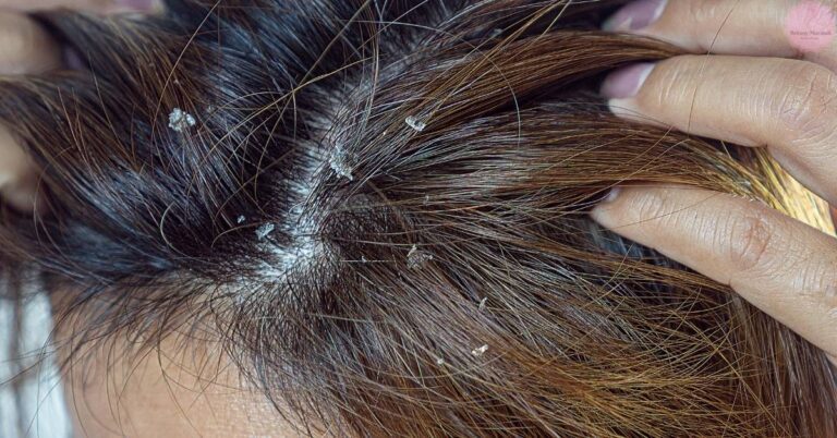 a close-up of an oily scalp with visible flakes and hair being parted, showing potential dandruff near hair follicles
