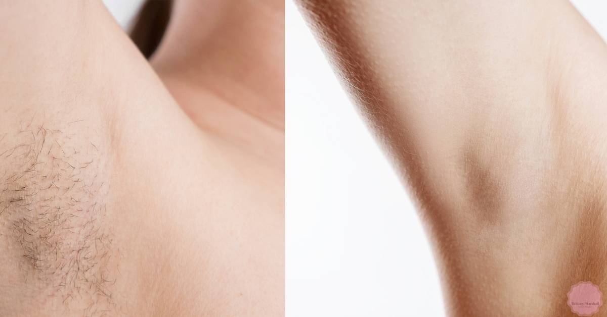 a close-up comparison of underarm skin with dense hair growth before and smooth, hair-free skin after hair removal.