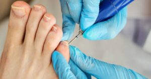 a medical professional treating a toenail condition with a topical application using a precision tool.