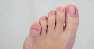 Pinky Toenail Grow Upwards