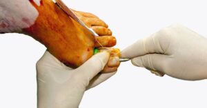 a medical professional performing a surgical ingrown toenail removal procedure on a patient’s toe.