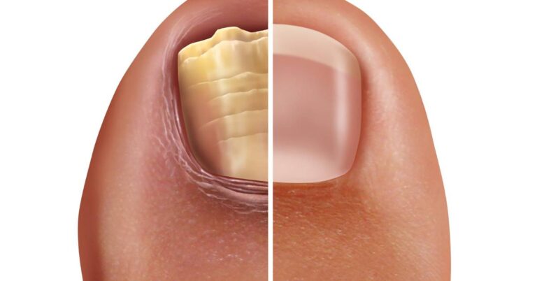 a before-and-after comparison of a discolored, thickened nail likely due to fungal infection and its restored healthy appearance post-treatment