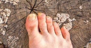 Does Kerasal Cause Nail Falling Off? A Closer Look [year]