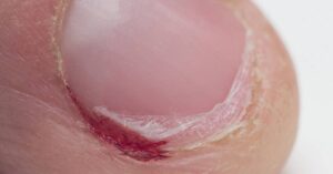 What To Do With Ripped Off Nail That Is Still Attached