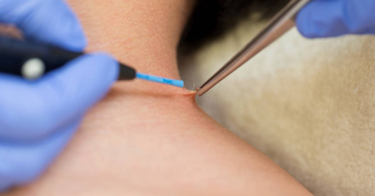 a person's skin having a small wart being carefully trimmed with nail clippers by gloved hands, showing potential risk of bleeding.